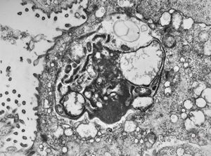 M,33y. | cryptosporidiosis - duodenum, im | munodeficient pacient